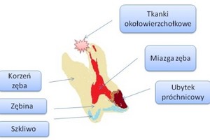 Ból zęba po borowaniu i założeniu plomby